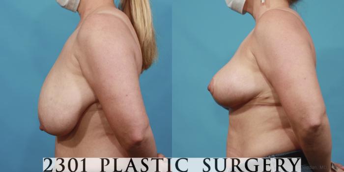 Before & After Breast Lift (Mastopexy) Case 646 Left Side View in Fort Worth, Plano, & Frisco, Texas