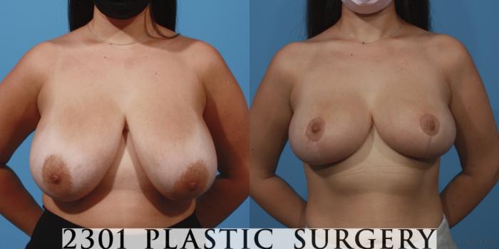 Before & After Breast Lift (Mastopexy) Case 647 Front View in Fort Worth, Plano, & Frisco, Texas