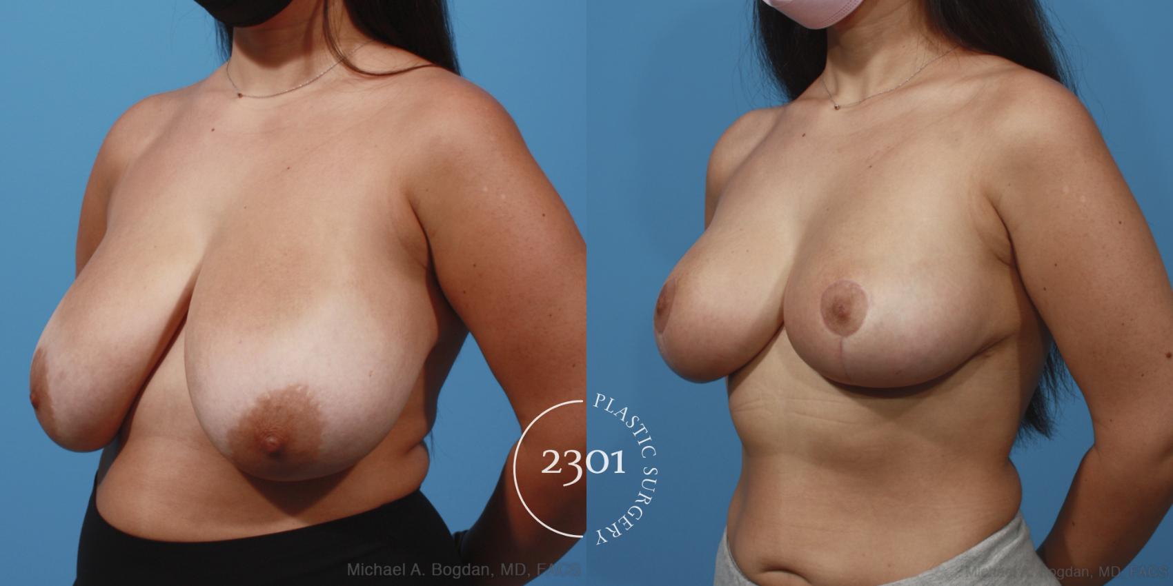 Before & After Breast Reduction Case 647 Left Oblique View in Fort Worth, Plano, & Frisco, Texas
