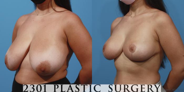 Before & After Breast Lift (Mastopexy) Case 647 Left Oblique View in Fort Worth, Plano, & Frisco, Texas