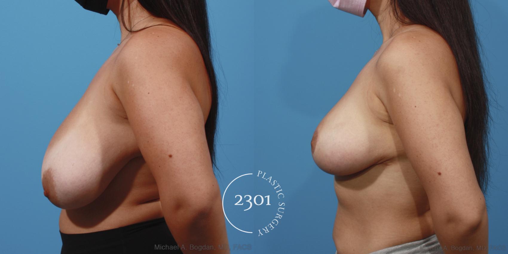Before & After Breast Reduction Case 647 Left Side View in Fort Worth, Plano, & Frisco, Texas
