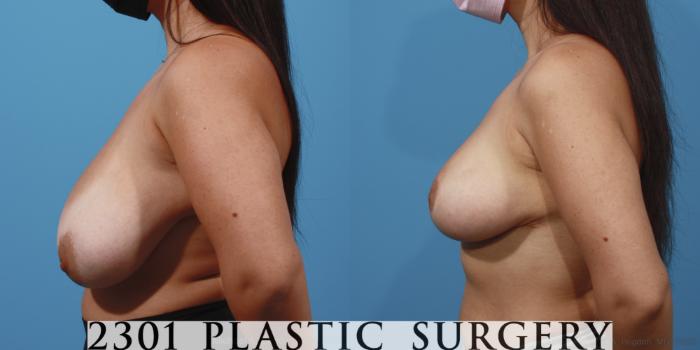 Before & After Breast Reduction Case 647 Left Side View in Fort Worth, Plano, & Frisco, Texas