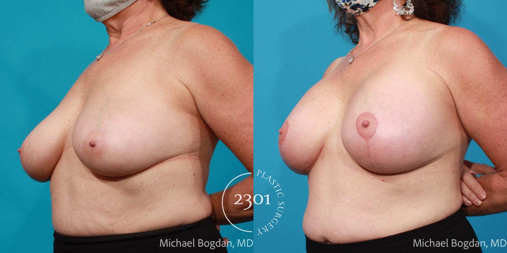 Before & After Breast Lift (Mastopexy) Case 670 Left Oblique View in Fort Worth, Plano, & Frisco, Texas