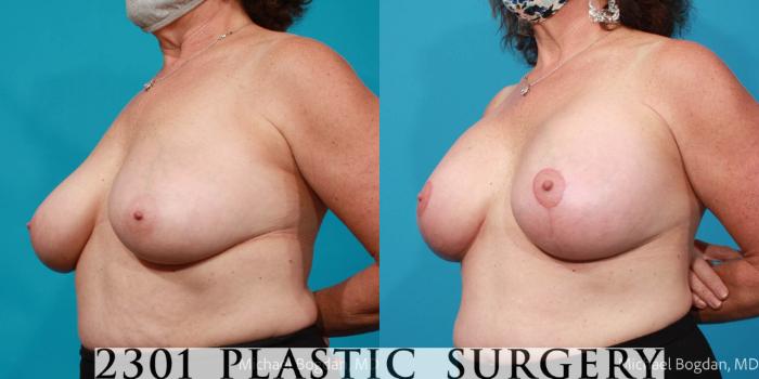 Before & After Breast Lift (Mastopexy) Case 670 Left Oblique View in Fort Worth, Plano, & Frisco, Texas
