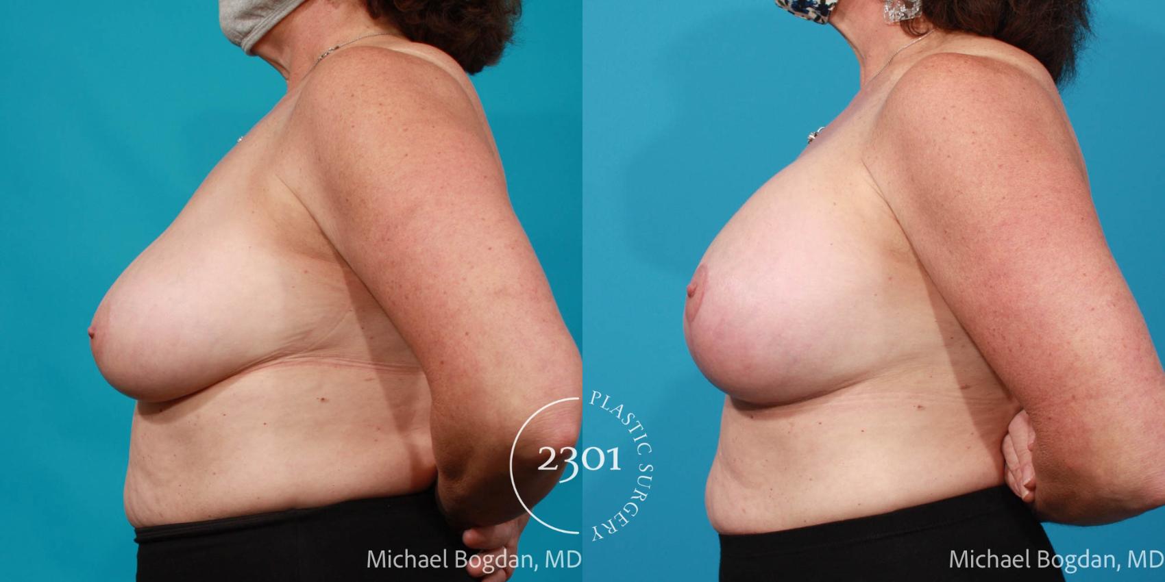Before & After Breast Lift (Mastopexy) Case 670 Left Side View in Fort Worth, Plano, & Frisco, Texas