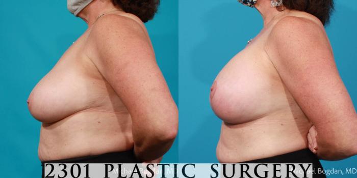 Before & After Breast Lift (Mastopexy) Case 670 Left Side View in Fort Worth, Plano, & Frisco, Texas