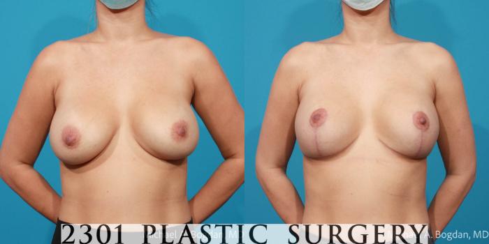 Before & After Breast Lift (Mastopexy) Case 671 Front View in Fort Worth, Plano, & Frisco, Texas