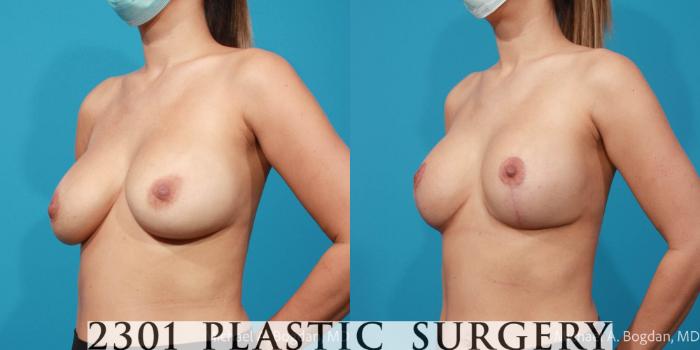 Before & After Breast Lift (Mastopexy) Case 671 Left Oblique View in Fort Worth, Plano, & Frisco, Texas
