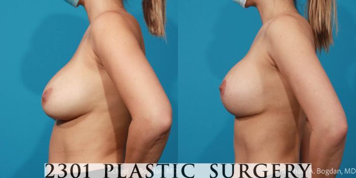 Before & After Breast Lift (Mastopexy) Case 671 Left Side View in Fort Worth, Plano, & Frisco, Texas
