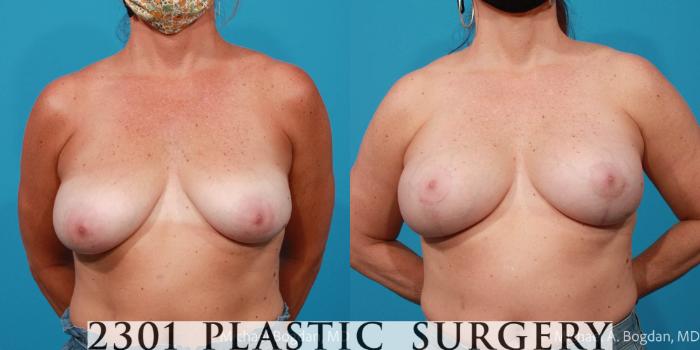 Before & After Breast Reduction Case 678 Front View in Fort Worth, Plano, & Frisco, Texas