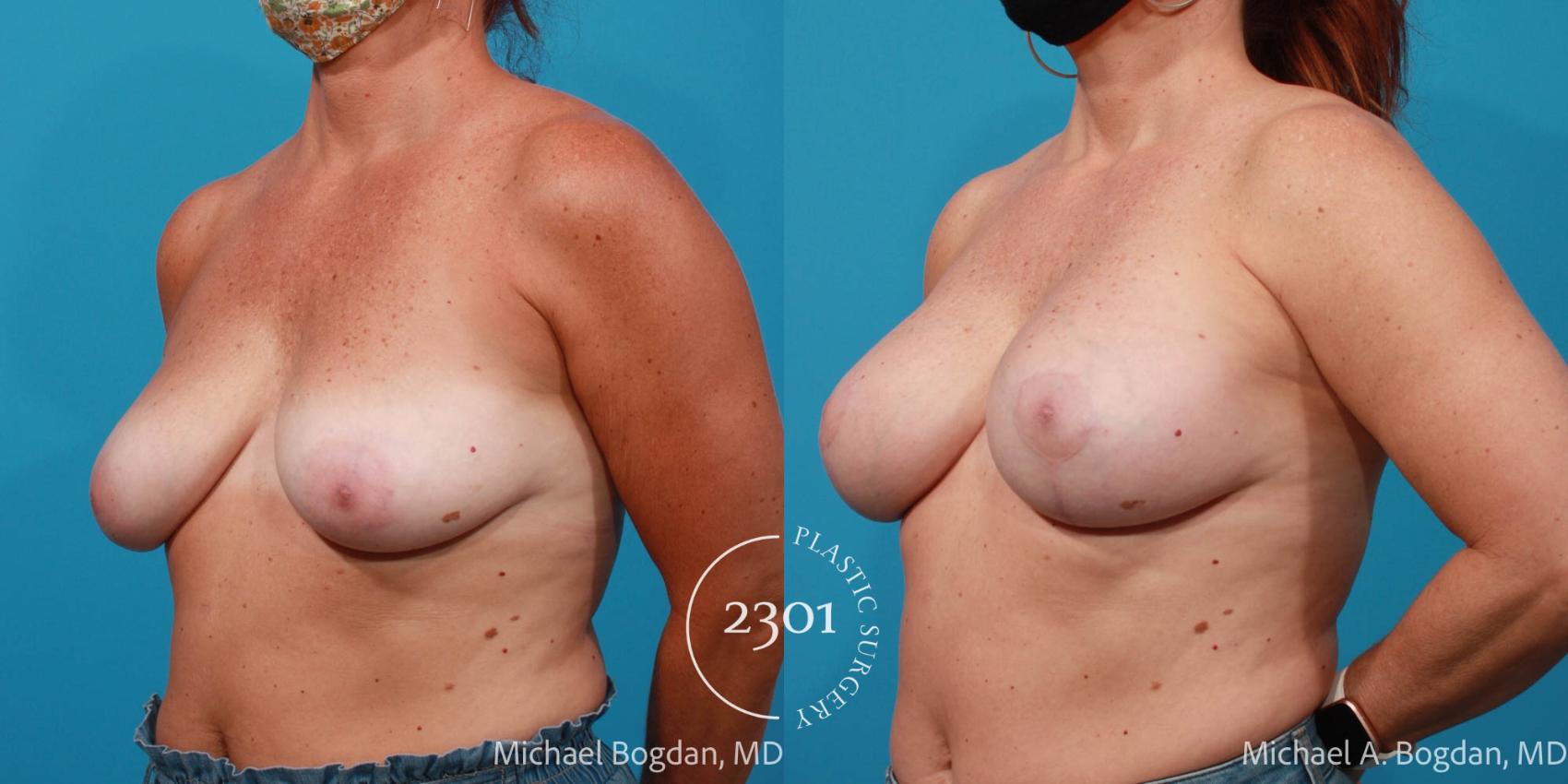 Before & After Breast Lift (Mastopexy) Case 678 Left Oblique View in Fort Worth, Plano, & Frisco, Texas