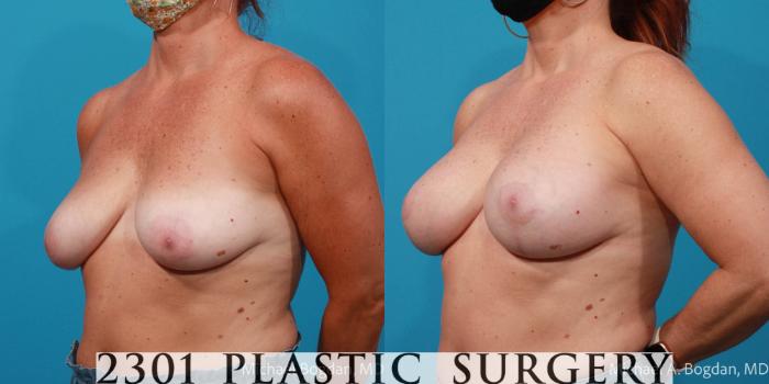Before & After Breast Reduction Case 678 Left Oblique View in Fort Worth, Plano, & Frisco, Texas