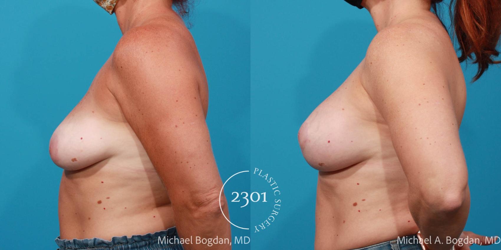 Before & After Breast Lift (Mastopexy) Case 678 Left Side View in Fort Worth, Plano, & Frisco, Texas