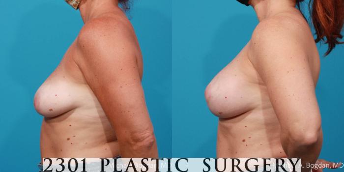 Before & After Breast Reduction Case 678 Left Side View in Fort Worth, Plano, & Frisco, Texas