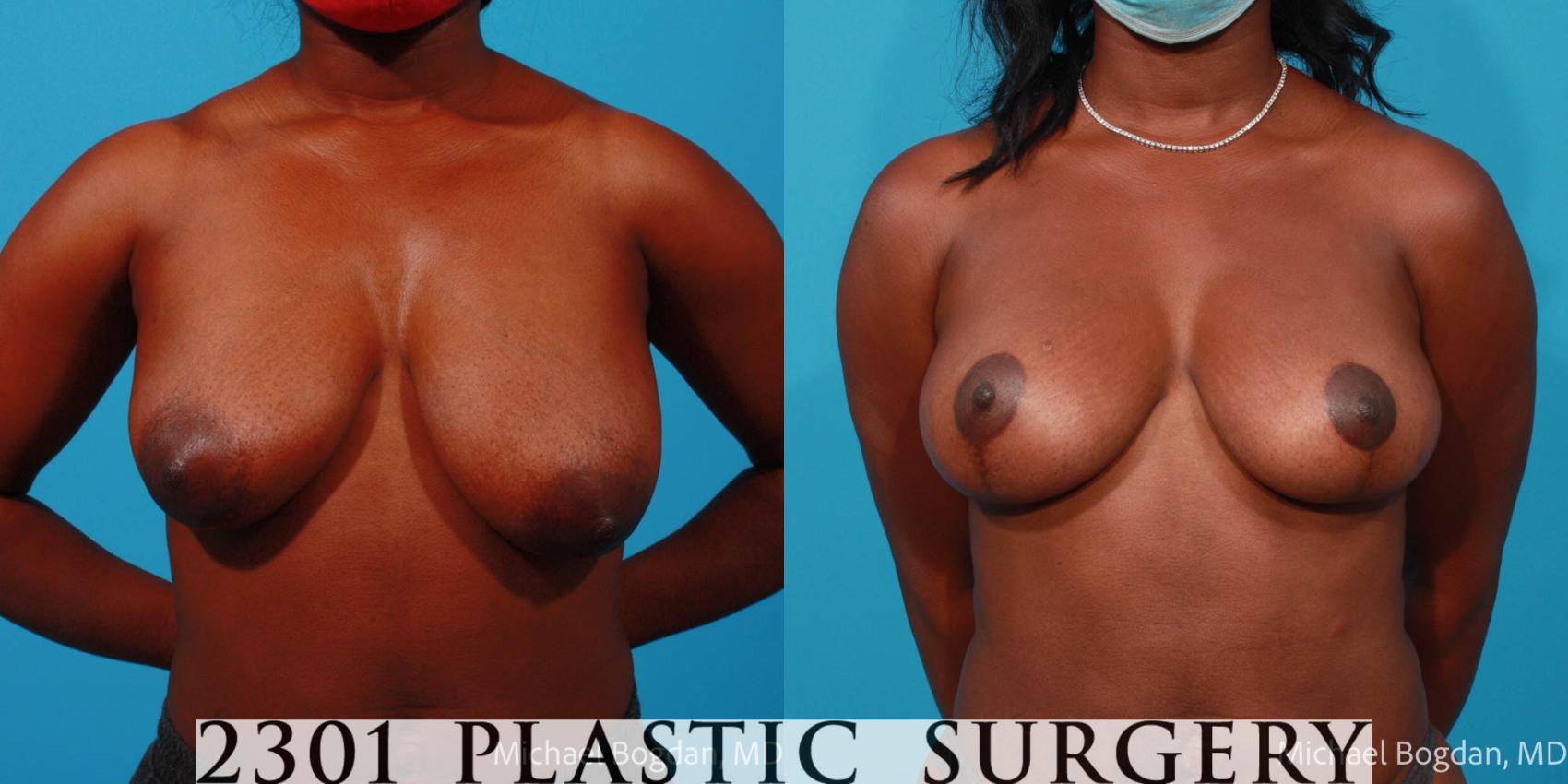 Before & After Breast Lift (Mastopexy) Case 689 Front View in Fort Worth, Plano, & Frisco, Texas