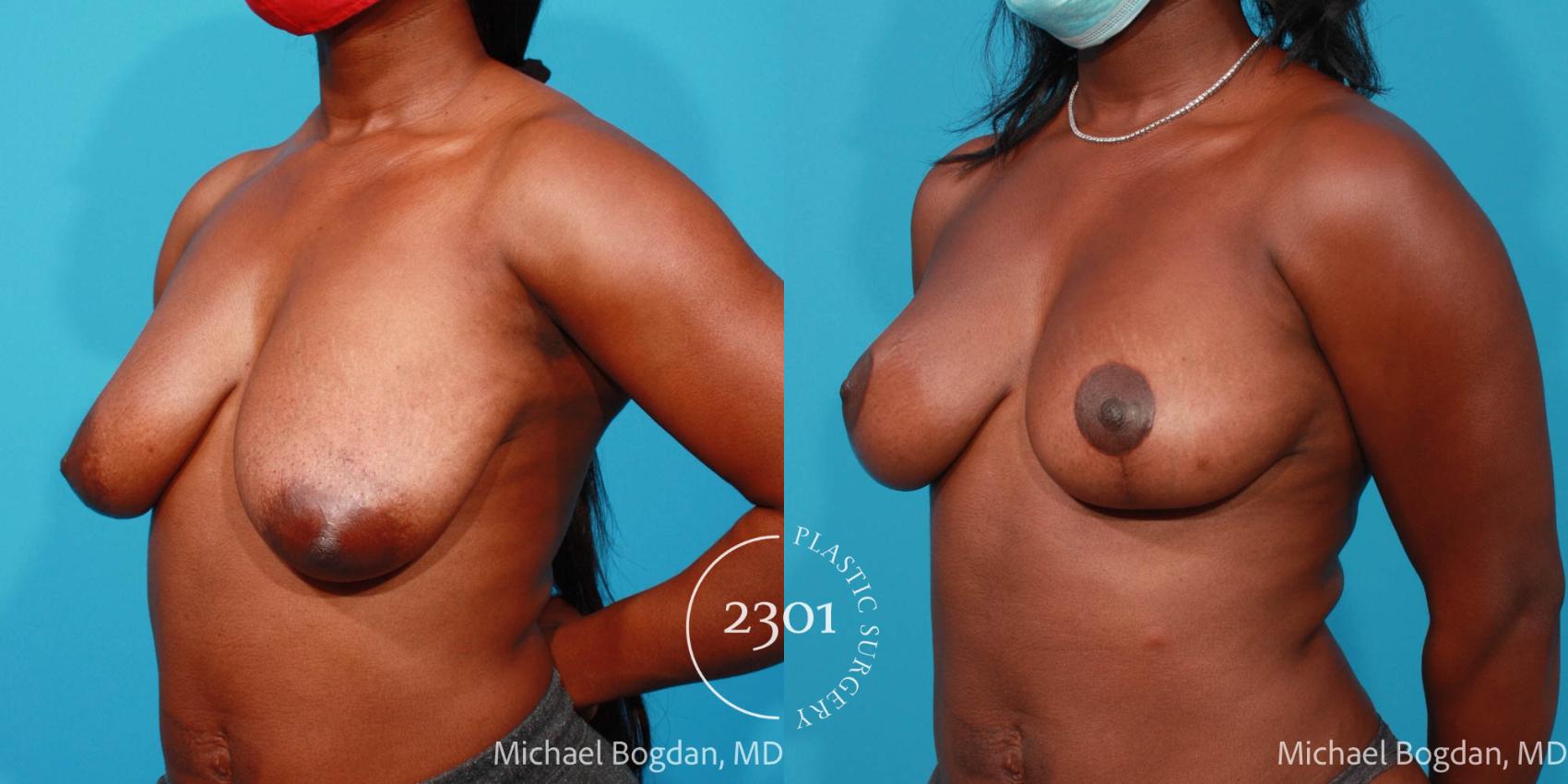 Before & After Breast Lift (Mastopexy) Case 689 Left Oblique View in Fort Worth, Plano, & Frisco, Texas