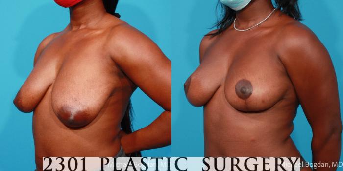 Before & After Breast Lift (Mastopexy) Case 689 Left Oblique View in Fort Worth, Plano, & Frisco, Texas