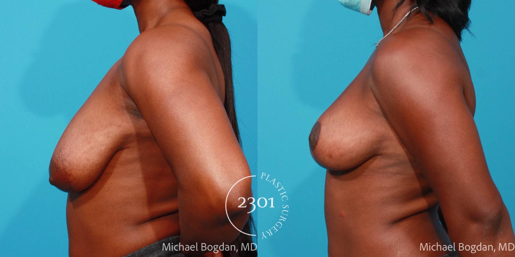 Before & After Breast Lift (Mastopexy) Case 689 Left Side View in Fort Worth, Plano, & Frisco, Texas