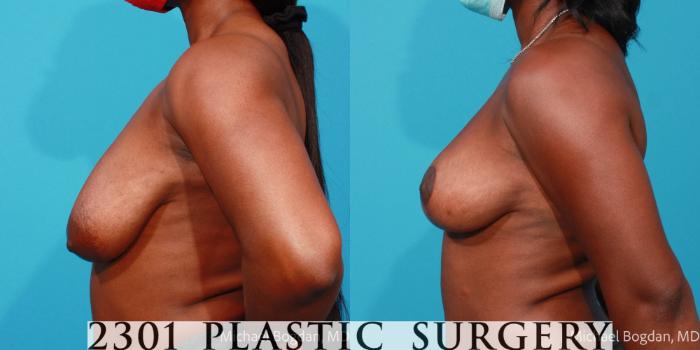 Before & After Breast Lift (Mastopexy) Case 689 Left Side View in Fort Worth, Plano, & Frisco, Texas