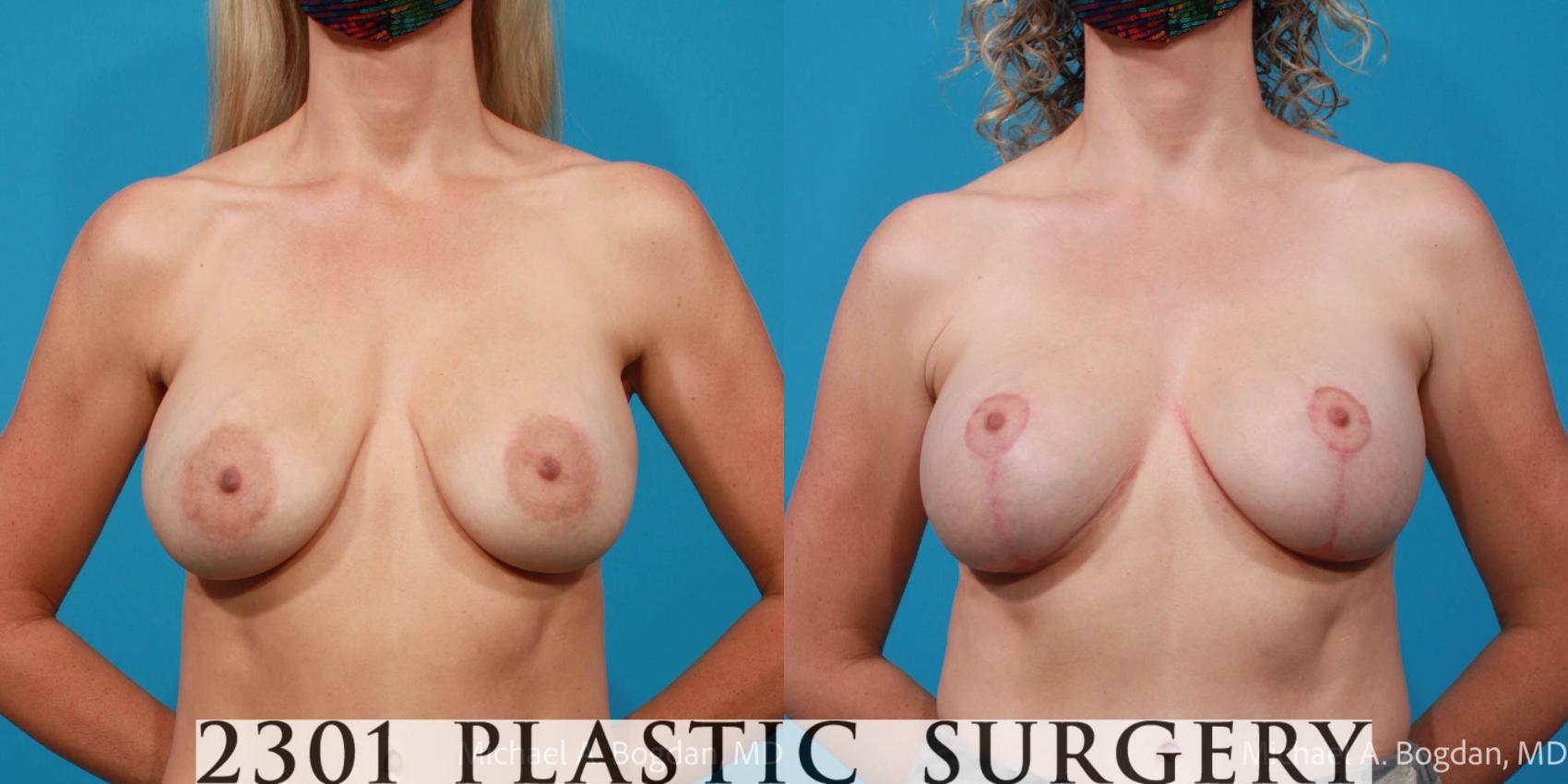 Before & After Breast Augmentation Revision Case 694 Front View in Fort Worth, Plano, & Frisco, Texas