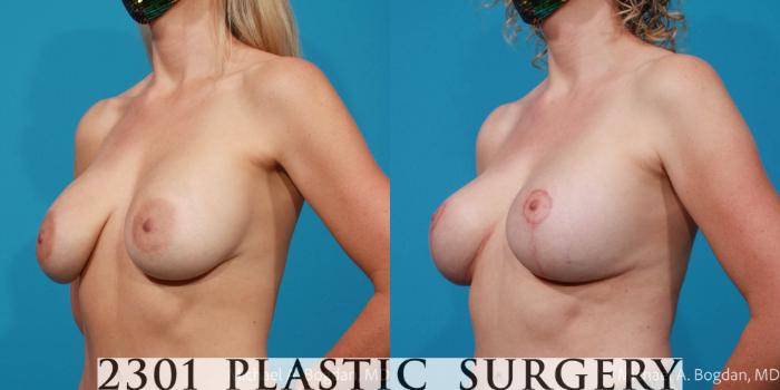 Before & After Breast Augmentation Revision Case 694 Left Oblique View in Fort Worth, Plano, & Frisco, Texas
