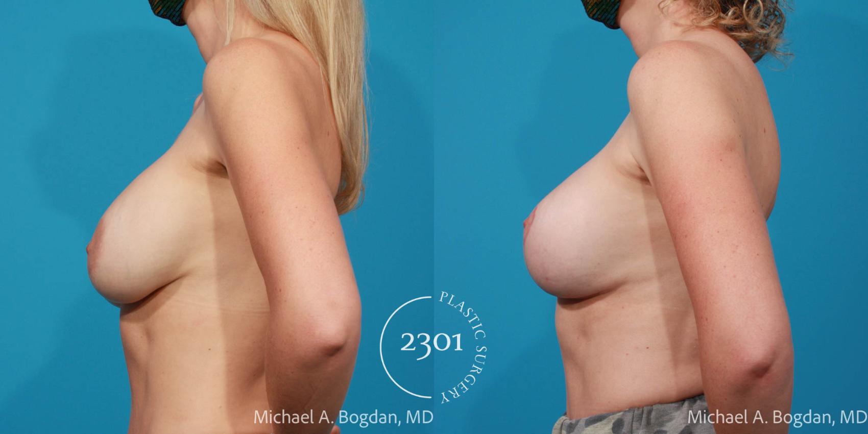 Before & After Breast Augmentation Revision Case 694 Left Side View in Fort Worth, Plano, & Frisco, Texas