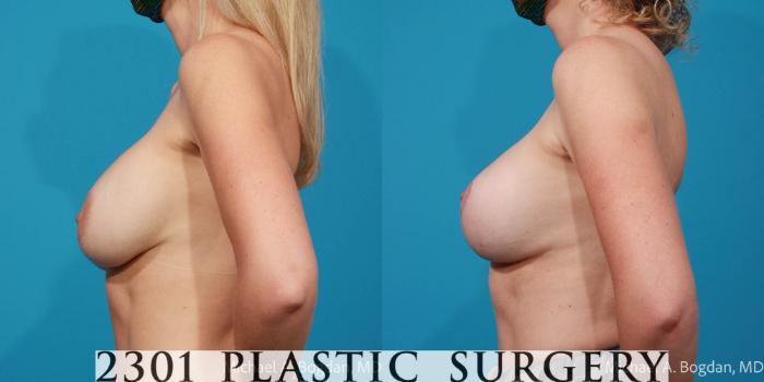 Before & After Breast Augmentation Revision Case 694 Left Side View in Fort Worth, Plano, & Frisco, Texas