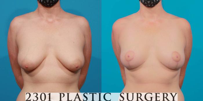 Before & After Breast Lift (Mastopexy) Case 723 Front View in Fort Worth, Plano, & Frisco, Texas