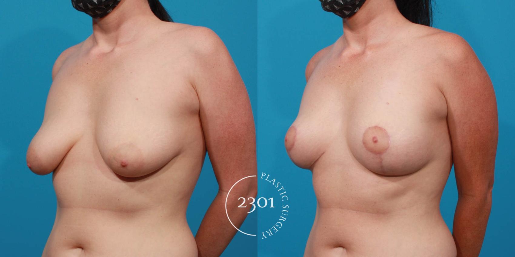 Before & After Breast Lift (Mastopexy) Case 723 Left Oblique View in Fort Worth, Plano, & Frisco, Texas