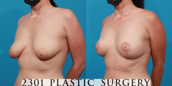 Before & After Breast Lift (Mastopexy) Case 723 Left Oblique View in Fort Worth, Plano, & Frisco, Texas