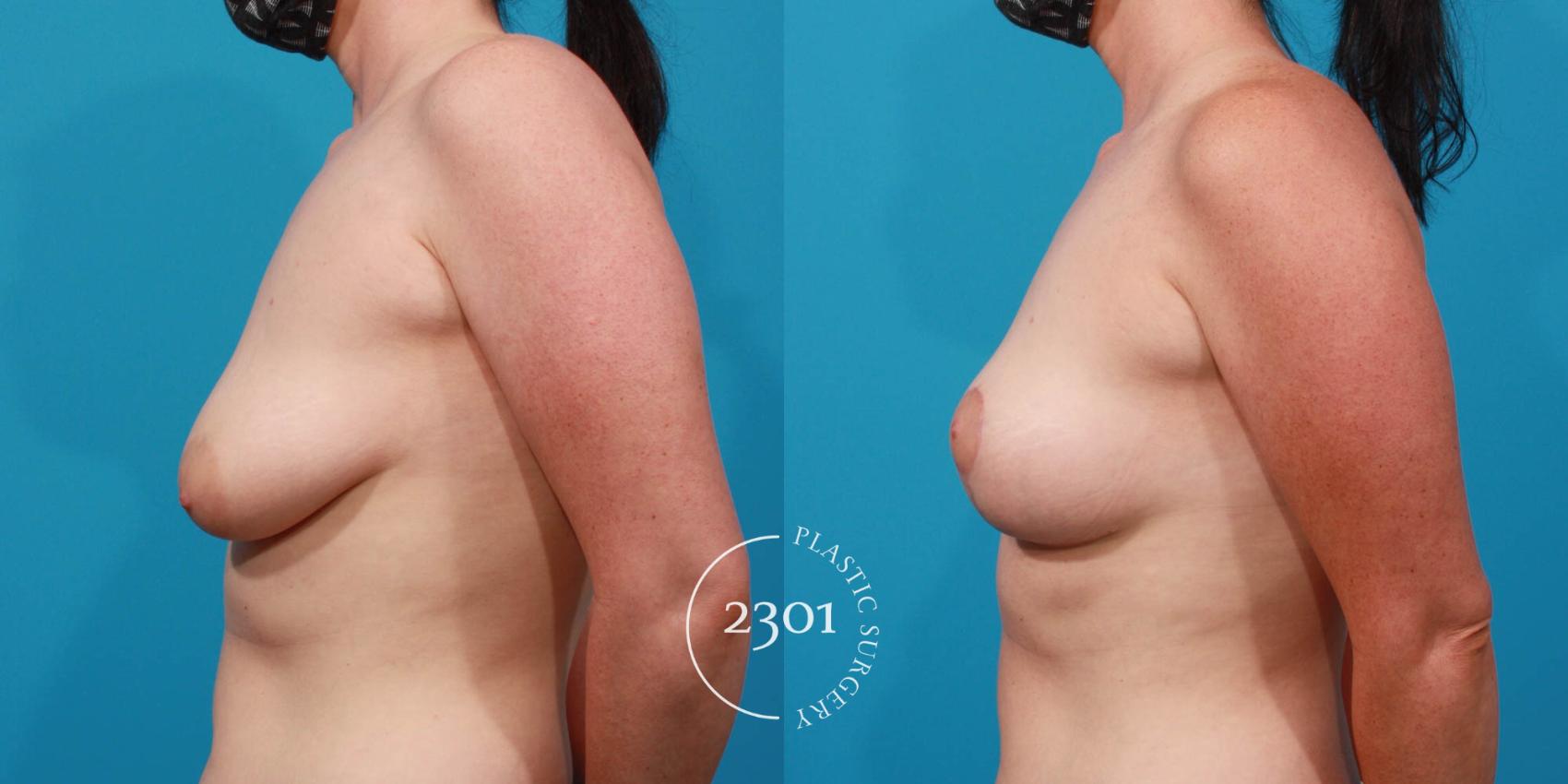 Before & After Breast Lift (Mastopexy) Case 723 Left Side View in Fort Worth, Plano, & Frisco, Texas