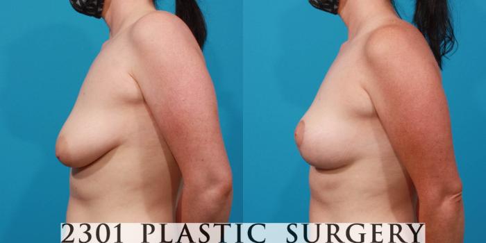 Before & After Breast Lift (Mastopexy) Case 723 Left Side View in Fort Worth, Plano, & Frisco, Texas