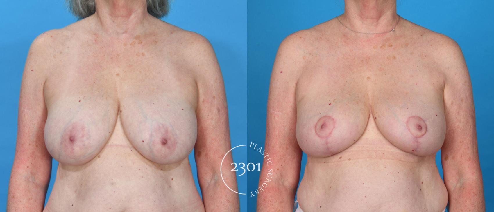 Before & After Breast Reduction Case 736 Front View in Fort Worth, Plano, & Frisco, Texas