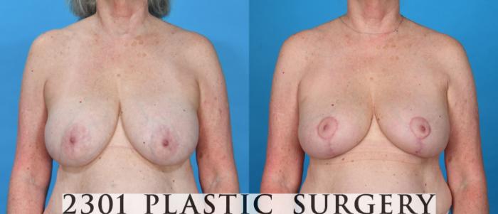 Before & After Breast Lift (Mastopexy) Case 736 Front View in Fort Worth, Plano, & Frisco, Texas