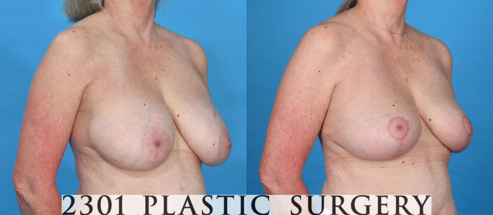 Before & After Breast Lift (Mastopexy) Case 736 Right Oblique View in Fort Worth, Plano, & Frisco, Texas