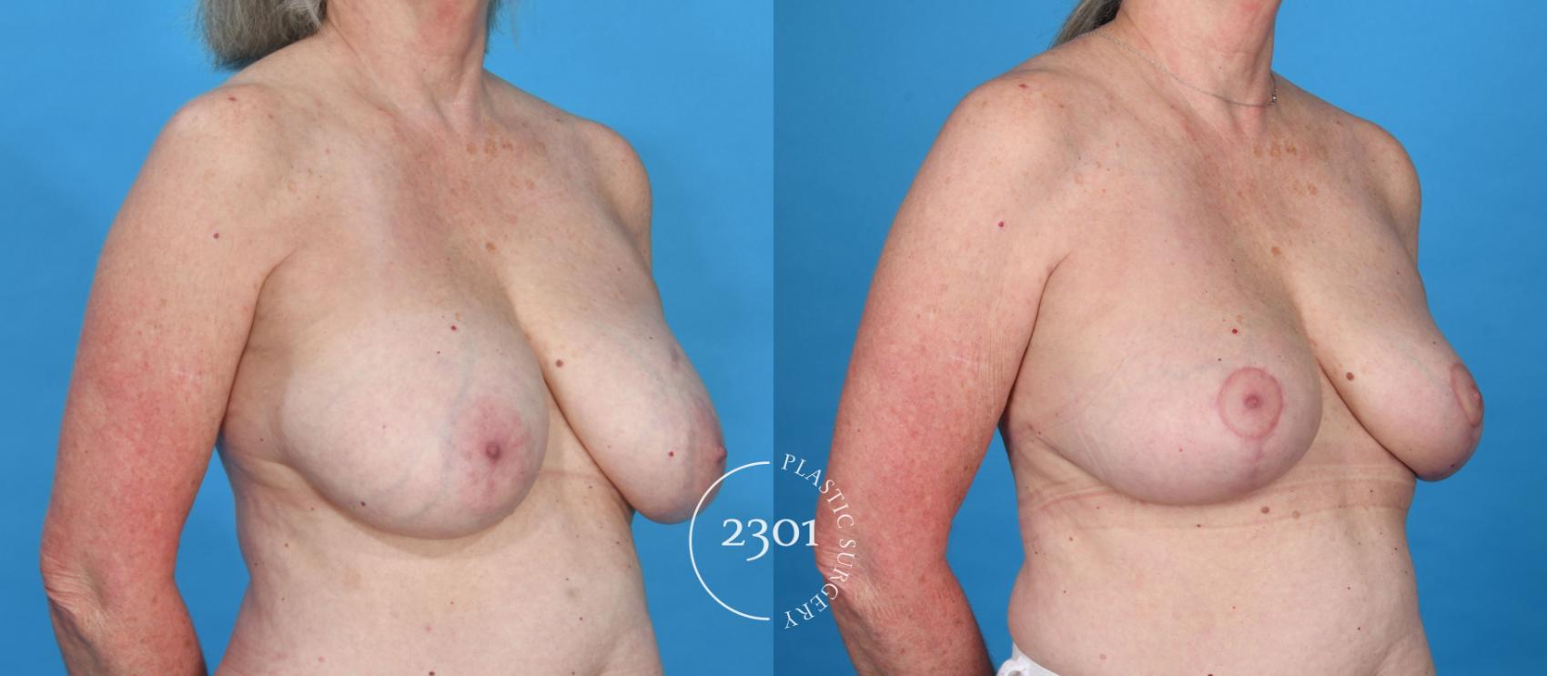 Before & After Breast Lift (Mastopexy) Case 736 Right Oblique View in Fort Worth, Plano, & Frisco, Texas