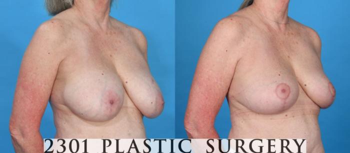 Before & After Breast Reduction Case 736 Right Oblique View in Fort Worth & Frisco, Texas