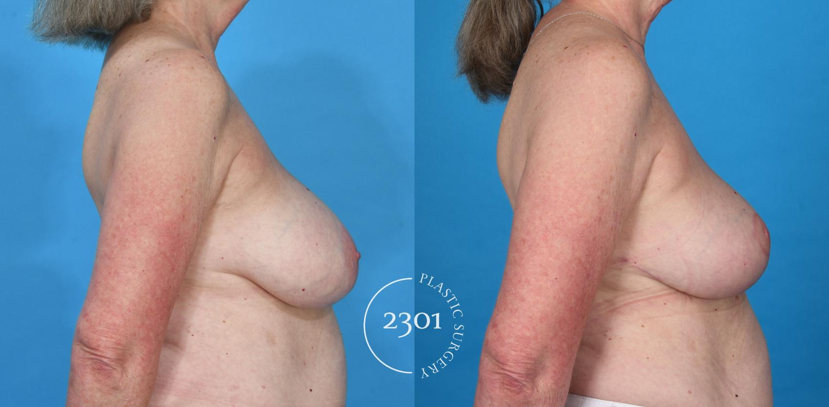 Before & After Breast Reduction Case 736 Right Side View in Fort Worth, Plano, & Frisco, Texas