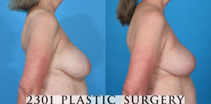 Before & After Breast Lift (Mastopexy) Case 736 Right Side View in Fort Worth, Plano, & Frisco, Texas