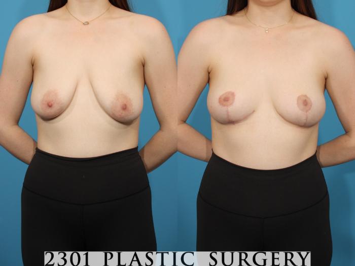 Before & After Breast Lift (Mastopexy) Case 785 Front View in Fort Worth, Plano, & Frisco, Texas