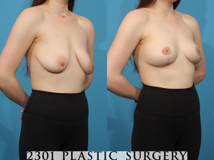 Before & After Breast Lift (Mastopexy) Case 785 Right Oblique View in Fort Worth, Plano, & Frisco, Texas