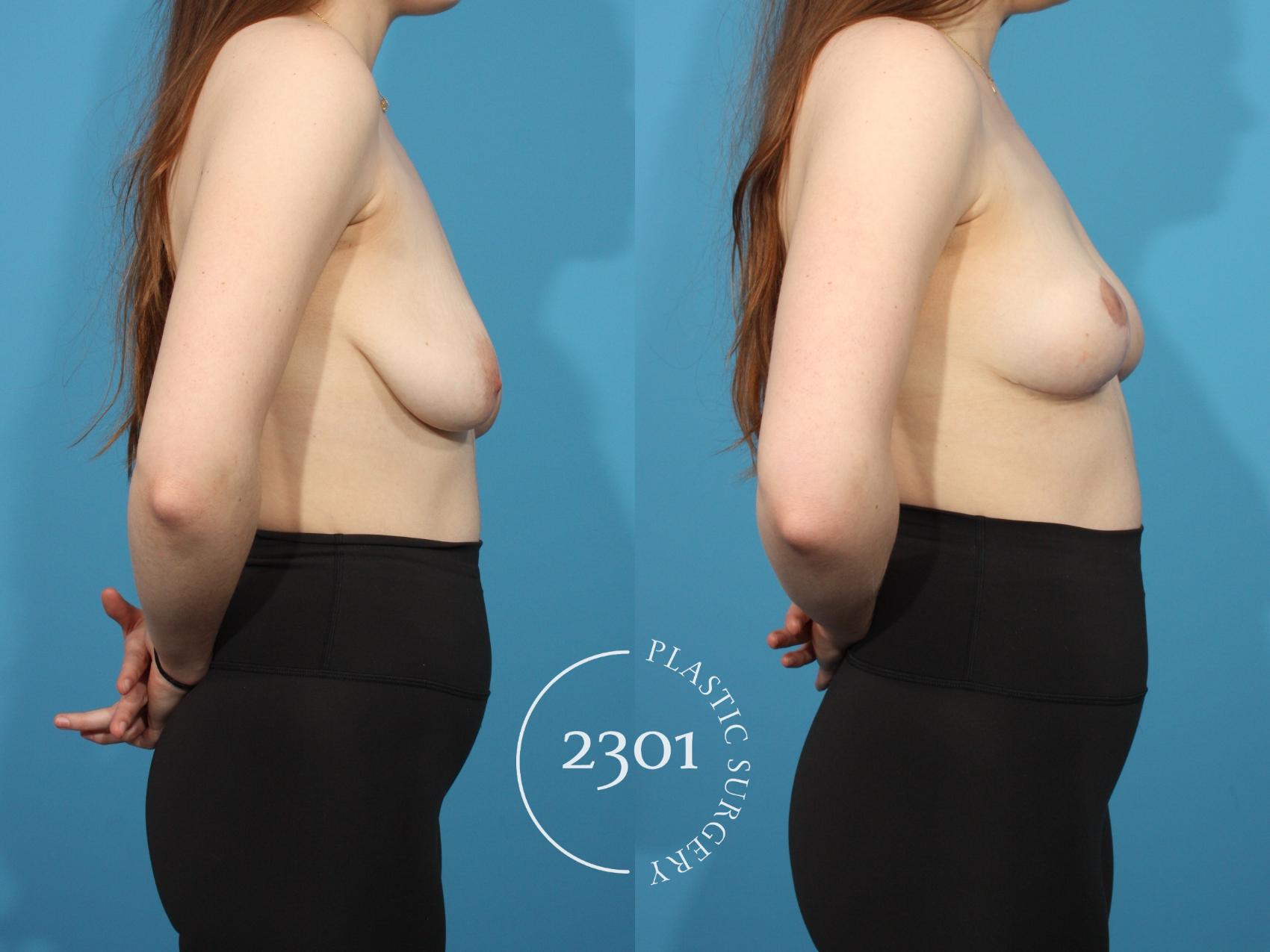 Before & After Breast Lift (Mastopexy) Case 785 Right Side View in Fort Worth, Plano, & Frisco, Texas