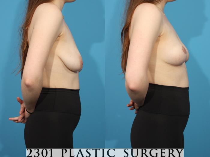 Before & After Breast Lift (Mastopexy) Case 785 Right Side View in Fort Worth, Plano, & Frisco, Texas