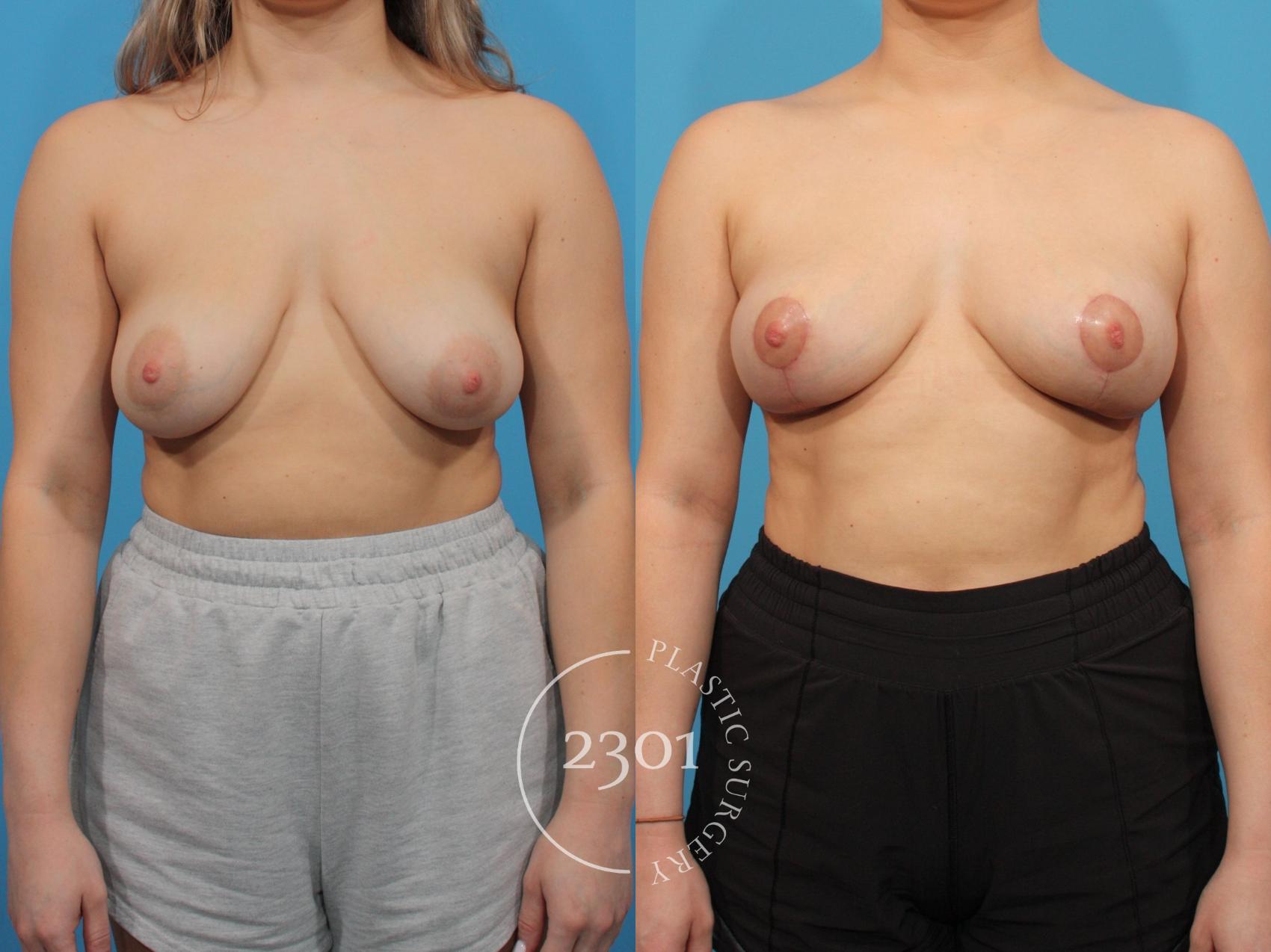 Before & After Breast Lift (Mastopexy) Case 786 Front View in Fort Worth, Plano, & Frisco, Texas
