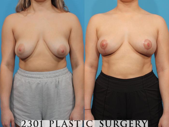 Before & After Breast Lift (Mastopexy) Case 786 Front View in Fort Worth, Plano, & Frisco, Texas