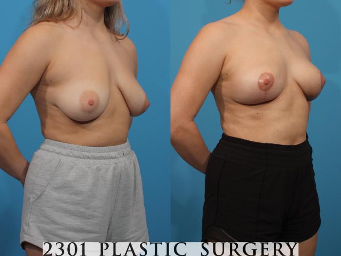 Before & After Breast Lift (Mastopexy) Case 786 Right Oblique View in Fort Worth, Plano, & Frisco, Texas