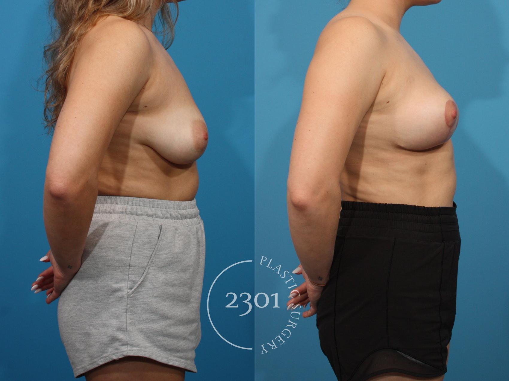 Before & After Breast Lift (Mastopexy) Case 786 Right Side View in Fort Worth, Plano, & Frisco, Texas