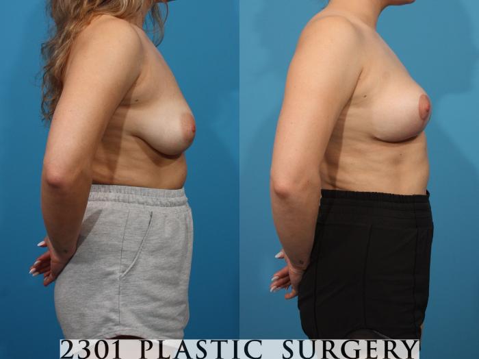 Before & After Breast Lift (Mastopexy) Case 786 Right Side View in Fort Worth, Plano, & Frisco, Texas