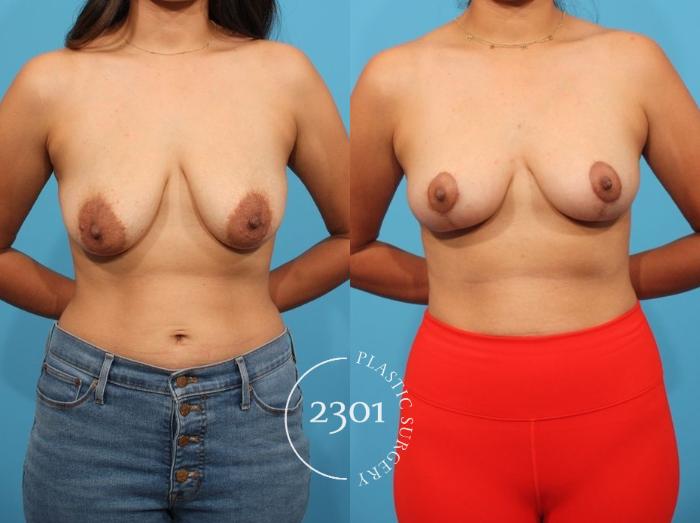 Before & After Breast Lift (Mastopexy) Case 806 Front View in Fort Worth, Plano, & Frisco, Texas