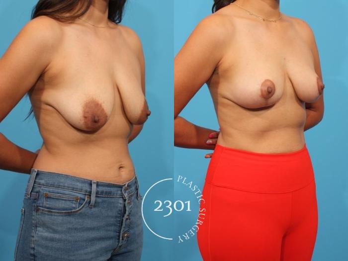 Before & After Breast Lift (Mastopexy) Case 806 Right Oblique View in Fort Worth, Plano, & Frisco, Texas